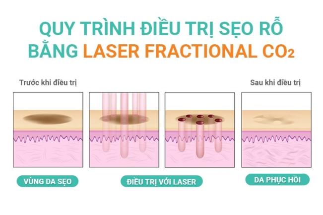 Laser Co2 Fractional là Công Nghệ Gì Mà Có Thể Giúp Bạn Quên Đi "Sẹo"