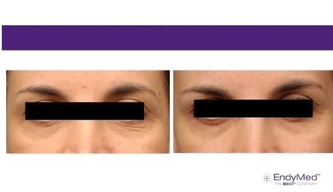 Khách hàng xóa nếp nhăn vùng mắt sau 2 lần điều trị bằng Endymed