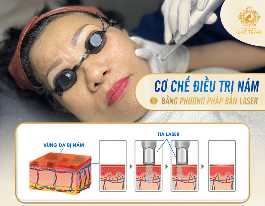 Bắn tia laser trị nám có hiệu quả không?