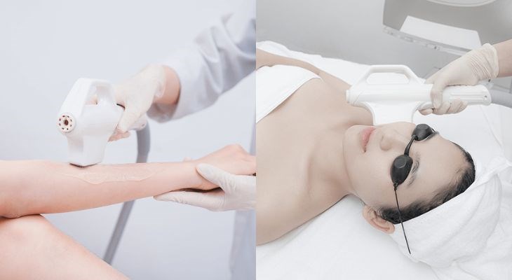 Lợi ích và nhược điểm của triệt lông bằng laser