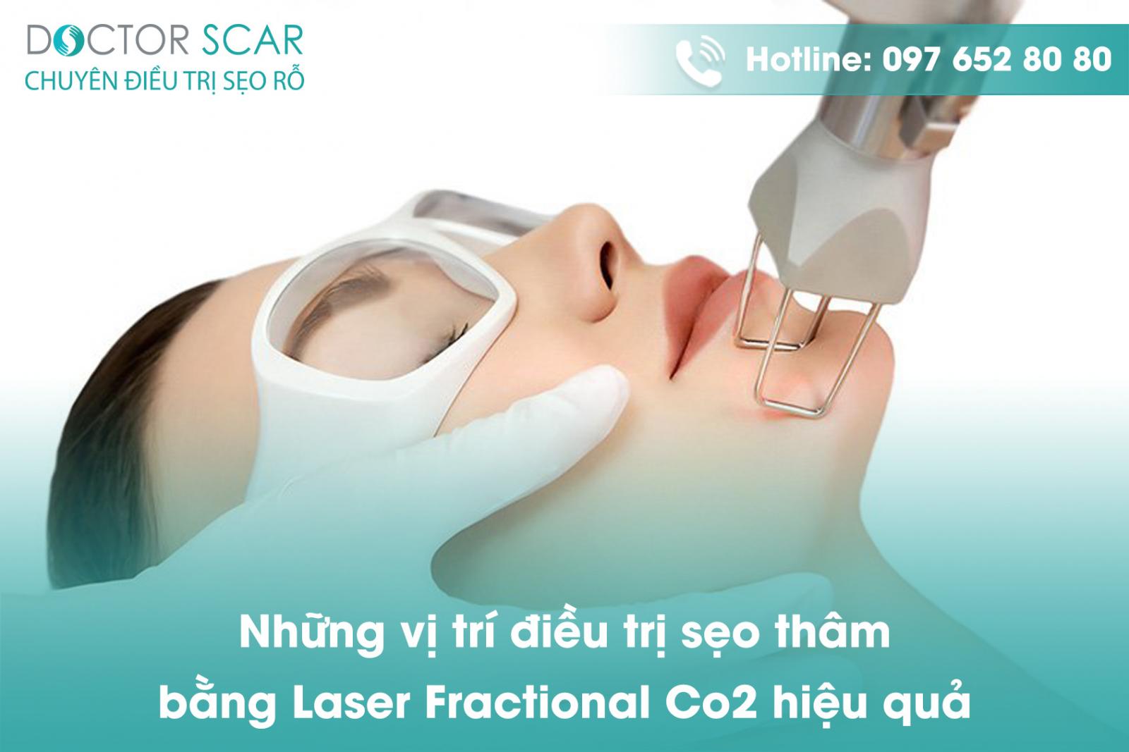 Trị thâm bằng laser có hiệu quả không?