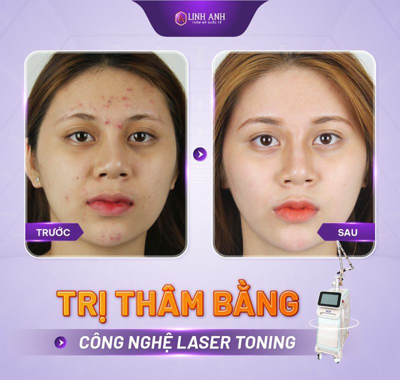 Trị thâm bằng laser có hiệu quả không?