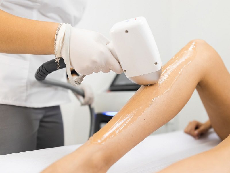 Triệt lông bằng tia laser có hại không?